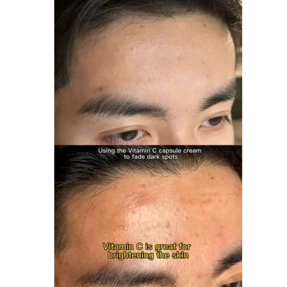 Two close-up forehead images showing skin tone and texture in a Vitamin C capsule cream promotional comparison Medicube Deep Vita C Capsule Cream Skin Comparison